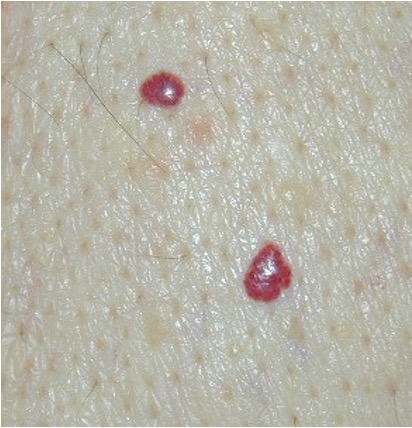 <p>small red papule</p>