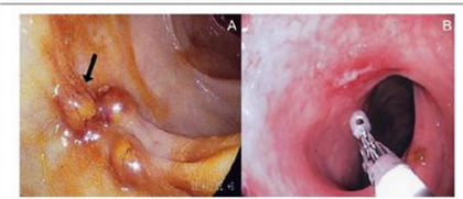 <p>Presents a blood; mucus-containing diarrhea (dysentery) accompanied by lower abdominal discomfort, flatulence (release of gas) and tenesmus (feeling of incomplete defecation)</p><ul><li><p>Chronic inflammation may occure, with symptoms such as occasional diarrhea, weight loss and fatigue</p></li><li><p>In some patients. a lesion called an amoeboma may form in the cecum or in the rectosigmoid area of the colon, which may be mistaken for a malignant tumor in the colon</p></li></ul><p></p>