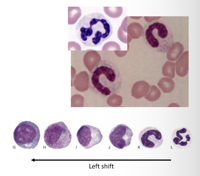 <p>Hallmark of acute/active infl </p><p>Immature neutrophil release as storage dec</p><p>Band neutrophil (non segmented nu)</p>