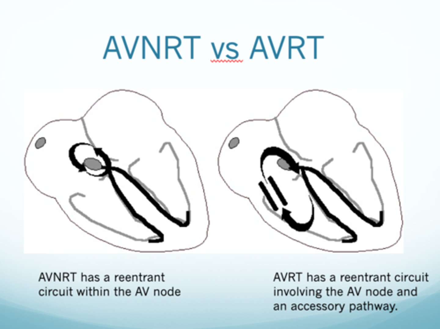<p>Type of SVT where there is a continuous loop circuit within the AV node itself leading to a tachycardic rate</p>