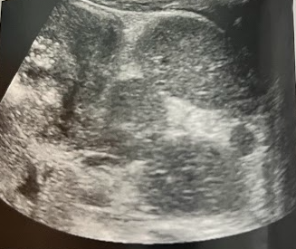 <p>A 5 month old girl w/clinical suspicion of splenomegaly undergoes an abdominal sonogram. Her clinical hx included an echo reporting an atrioventricular canal defect, chest x-ray illustrating an interrupted IVC, and possible situs ambiguous. The sonogram revealed the liver to be located more central midline and the spleen to be abnormal in location and appearance. This image was obtained in trans to the lf of the midline in the region of the spleen. Describe the sonographic findings and congenital associations for this appearance</p>