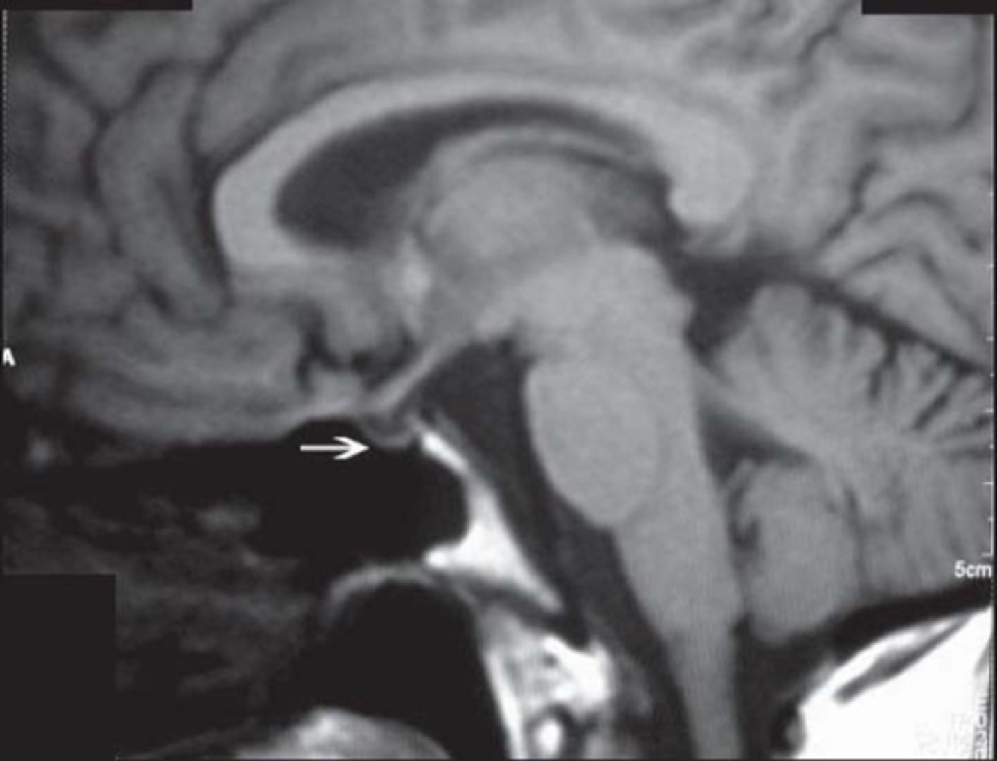<p>Sheehan syndrome (pituitary infarction)</p>