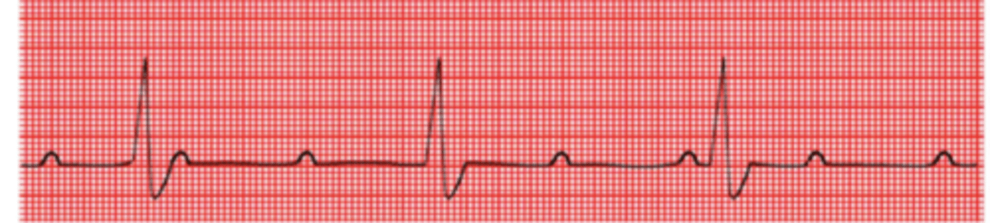 <p>what type of arrhythmia do we see here?</p>