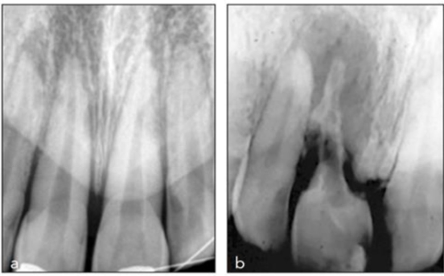 <p>Patient presents with history of trauma, does not respond to sensibility tests (necrotic pulp), is tender to percussion and/or palpation and has these radiographic findings. What is the most likely diagnosis? </p>