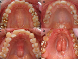 <p>an exostosis that <span style="color: red;">occurs in one of two locations</span> intra-orally</p><p><span style="color: red;">benign protuberances of bone</span><span style="color: rgb(204, 0, 0);"> </span>that may arise on the cortical surface of the jaws</p><ul><li><p><strong>treatment:</strong></p><ul><li><p><span style="color: red;">surgical removal </span>may be required if removable prostheses are planned</p></li></ul></li></ul><p></p>
