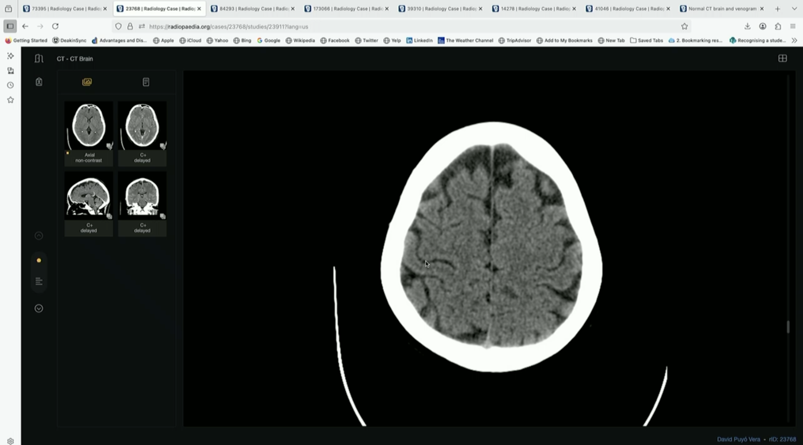 <p>Where is Central Sulcus? + Lobes + Gyrus</p>
