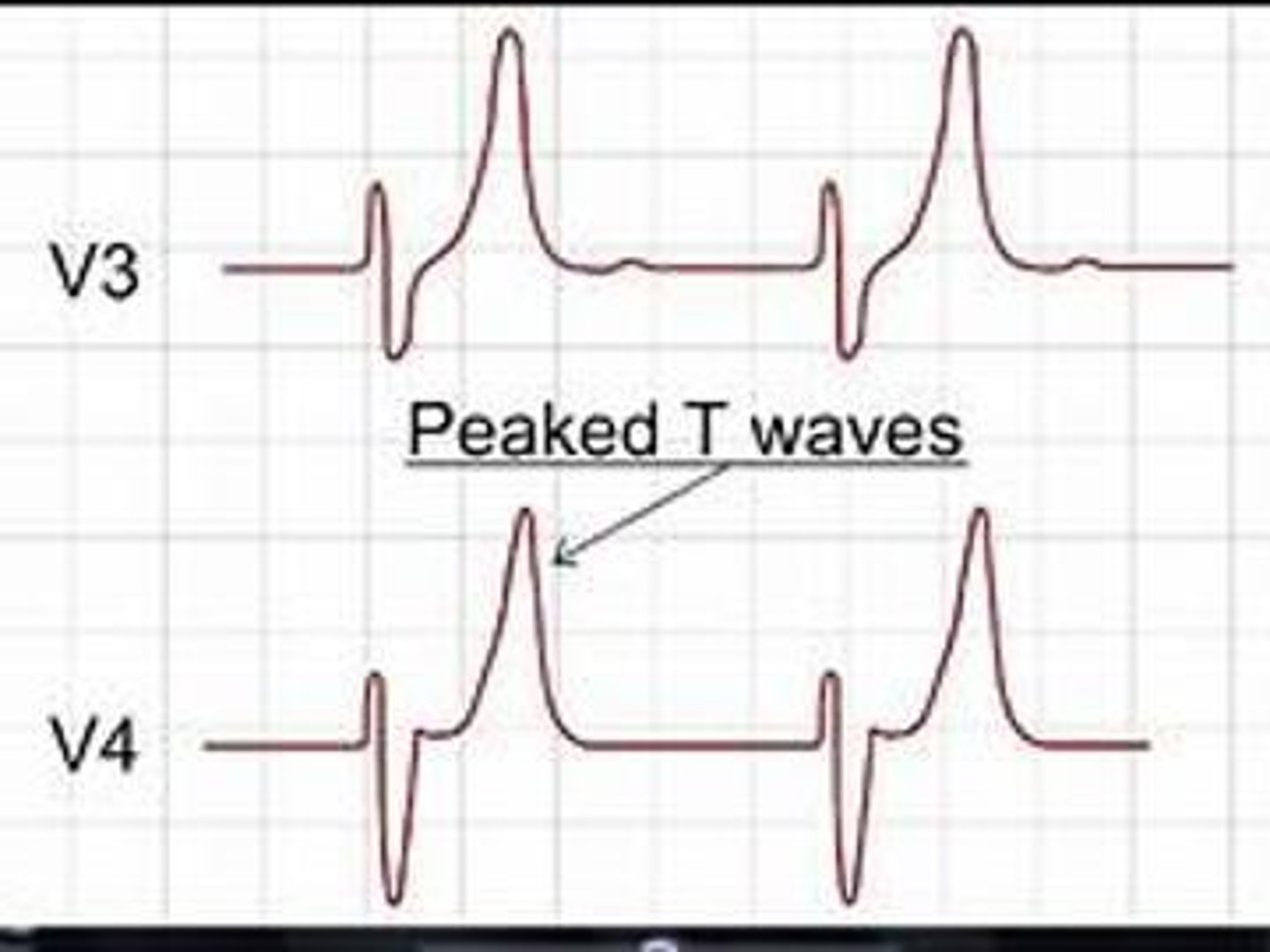 <p>Causes: Increased intake, shift from ICF to ECF, decreased renal loss, metabolic acidosis, insulin deficiency, cell trauma. Manifestations: Mild attacks (tingling of lips and fingers, restlessness, intestinal cramping and diarrhea, peaked T-waves on ECG), severe attacks (muscle weakness, loss of muscle tone, paralysis).</p>