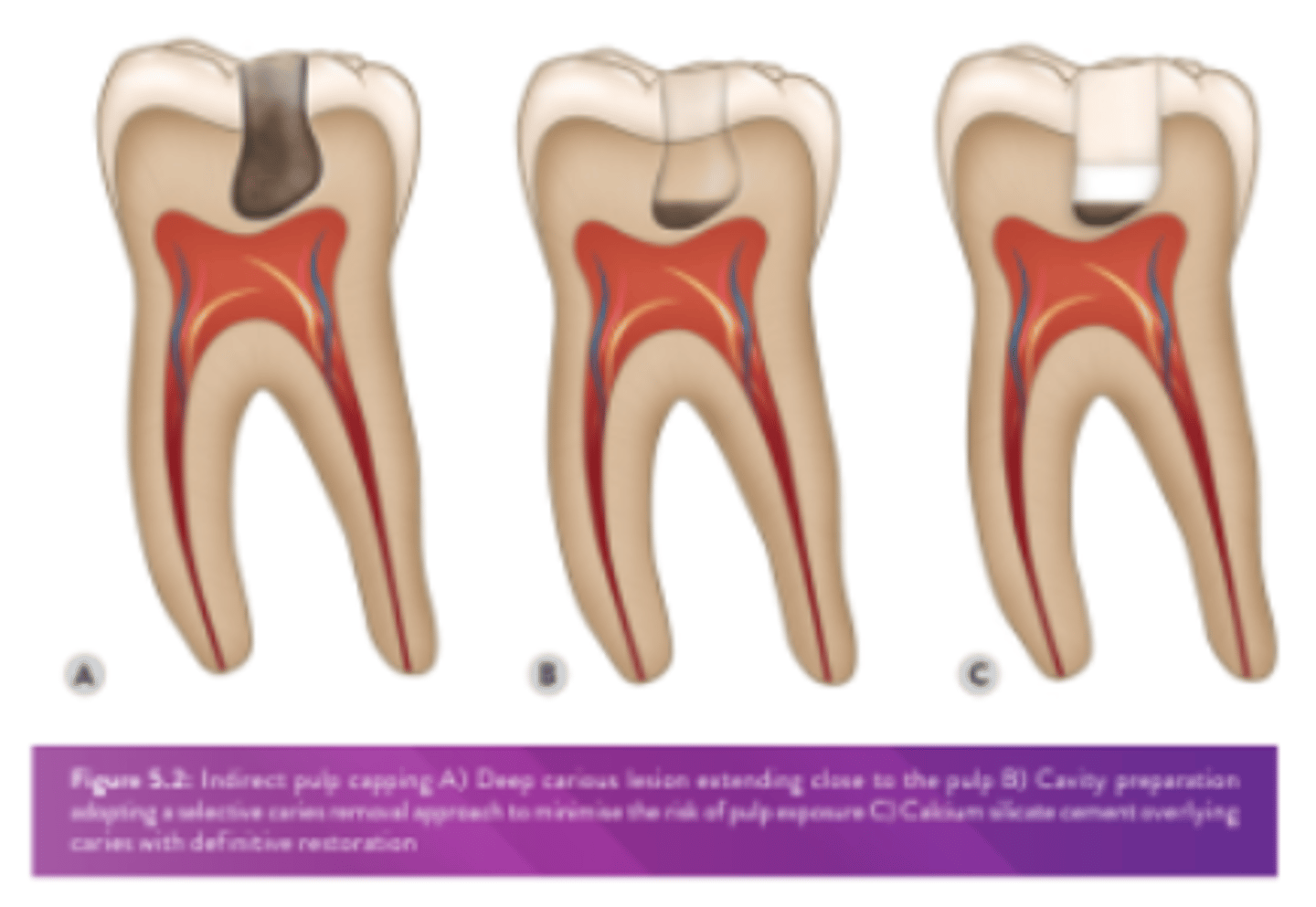 <p>dentine is lost due to caries, trauma or a prev iatrogenic intervention &amp; a cavity exists which is close to the pulp but dentine still remains over the pulp tissue</p>