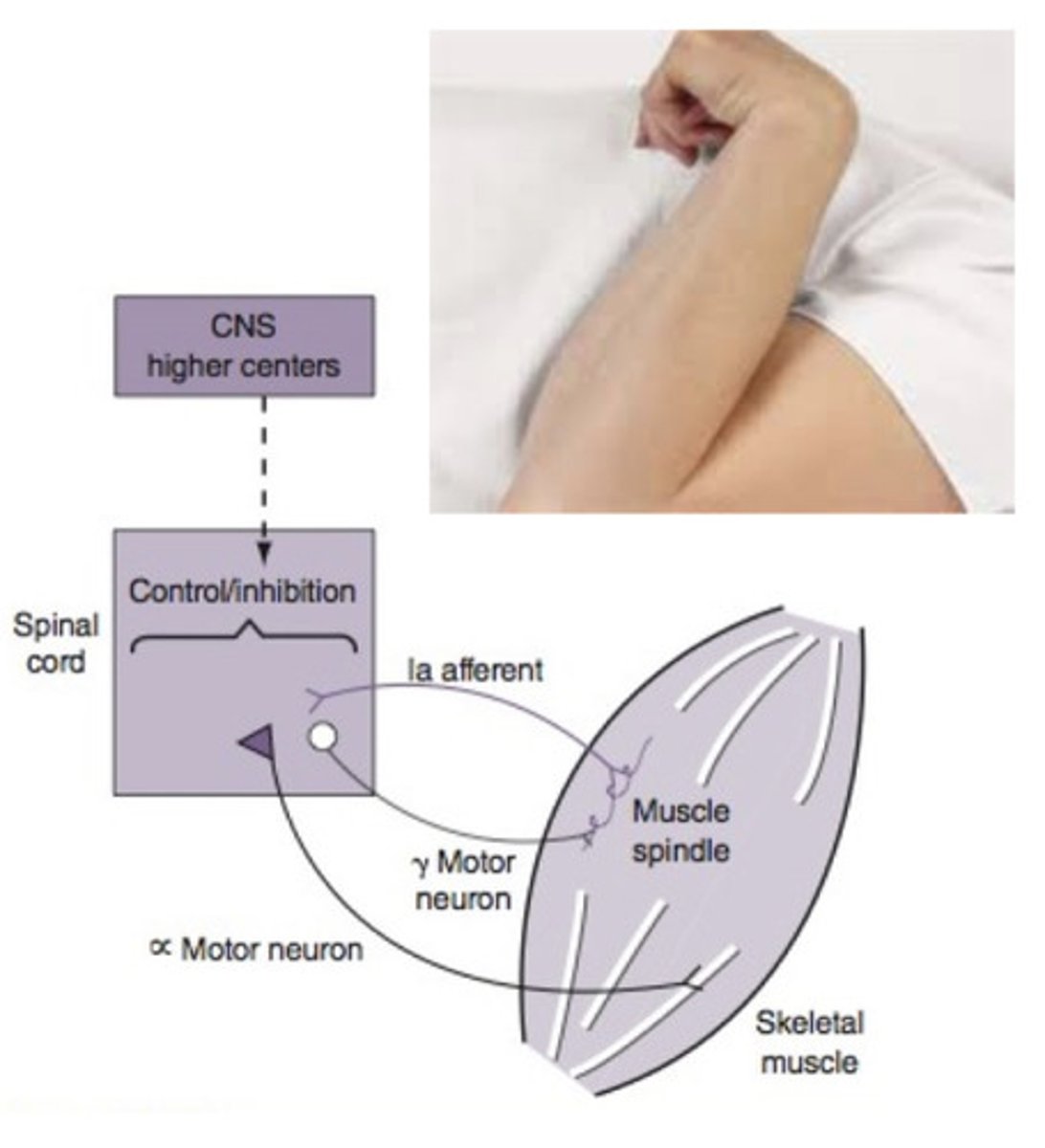 <p>a hallmark sign of UMN damage</p><p>- hyperactive reflexes (clonus)</p><p>- increased tone</p>