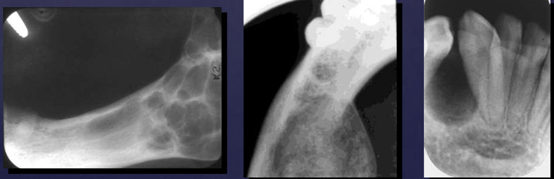 <p>Radiolucent or mixed</p><p><span data-name="black_small_square" data-type="emoji">▪</span> radiopaque flecks seen in mixed</p><p>lesions</p><p><span data-name="black_small_square" data-type="emoji">▪</span> Septations, loculations</p><p>(multilocular lesions)</p>