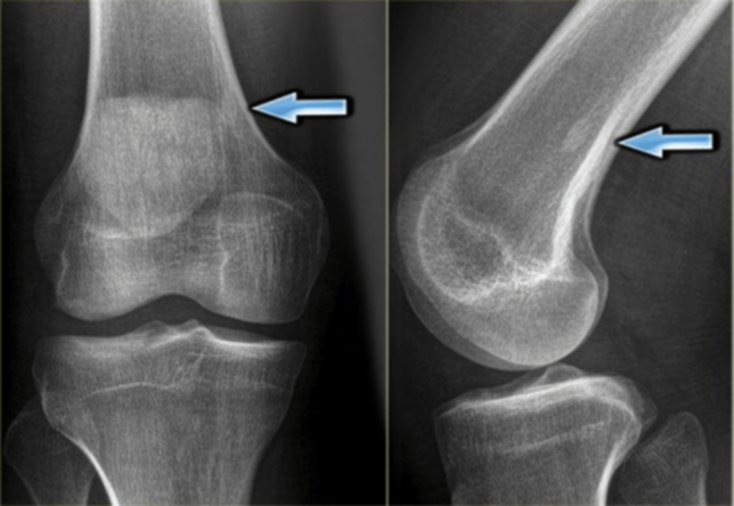 <p>Osteoblastic/sclerotic bone lesion - is this diffuse or local?</p>