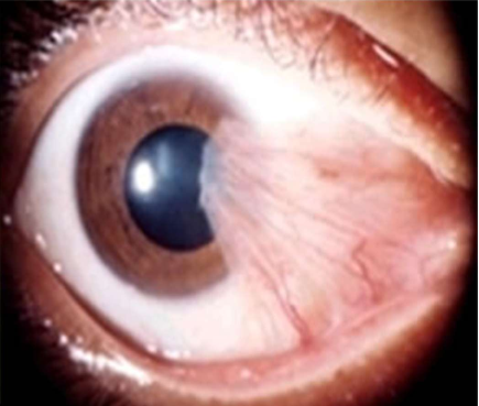 <ul><li><p>when removed they often come back</p></li><li><p>can cause induced astigmatism</p></li></ul><p></p>