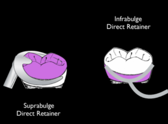 <p>what is infrabulge clasp?</p>
