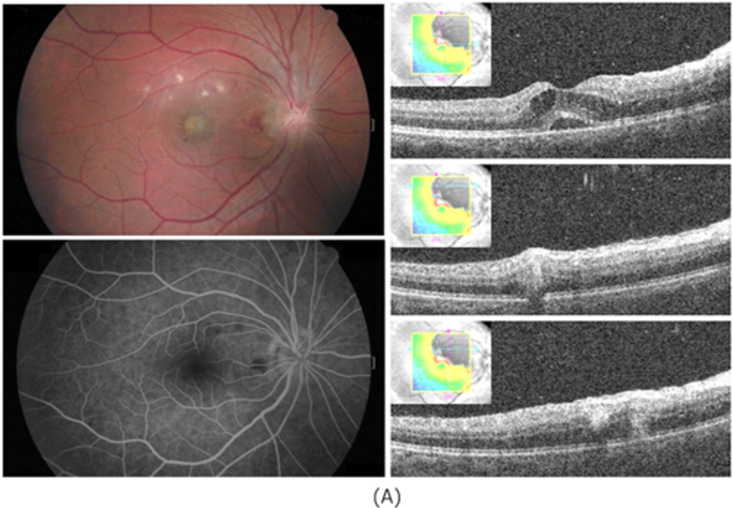 <p>multiple light granulomas = hyperR </p>