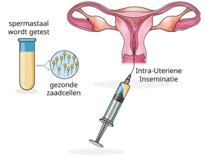 <p>2) kunstmatige inseminatie</p>
