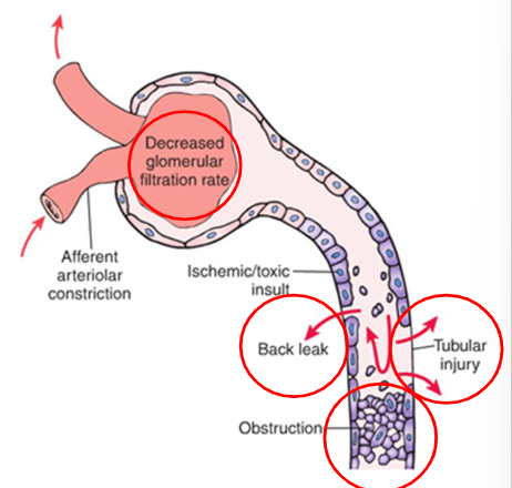 <p><u>destruction of renal tubule epithelial cells w suppression of renal function</u><br>– damage leads to necrosis of epithelial cells which obstruct lumen of renal tubule →↑ pressure in lumen →↓glomerular filtration. fluid leaks from nephron into interstitial tissue</p>