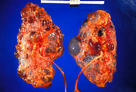 <p><strong>A 22-year-old female with a history of intermittent flank pain, repeated UTIs, and hematuria has been diagnosed with autosomal dominant polycystic kidney disease (ADPKD). Which of the following phenomena has most likely contributed to the development of this diagnosis?</strong></p><p>A) UTIs coupled with an impaired immune response have caused her ADPKD.</p><p>B) She has inherited a tendency for epithelial cells in her tubules to proliferate inappropriately.</p><p>C) Severe hypertension and portal hypertension are likely precursors.</p><p>D) She has inherited undersized kidneys that are prone to calculi</p><p>formation. </p>
