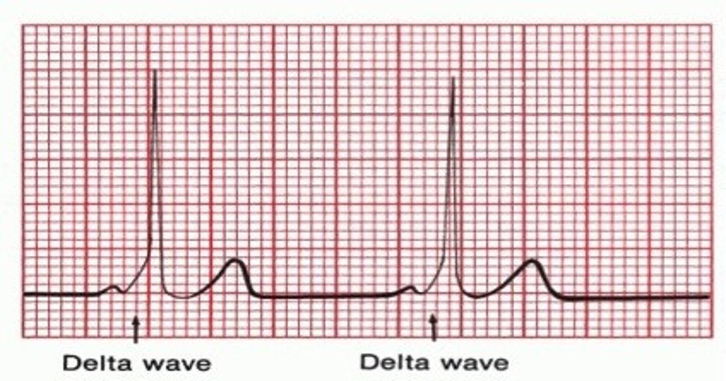 <p>delta wave, wide WRS, short PRi</p>