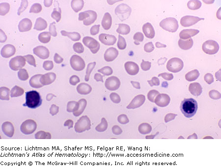Hallazgos clínicos de beta-talasemia