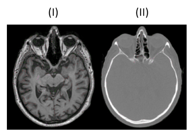 <ul><li><p>Strahlenfrei</p></li><li><p>hohe Bildqualität</p></li><li><p>Weichteildarstellung </p></li><li><p>Flexibilität bei Schnittführung</p></li></ul><p></p>