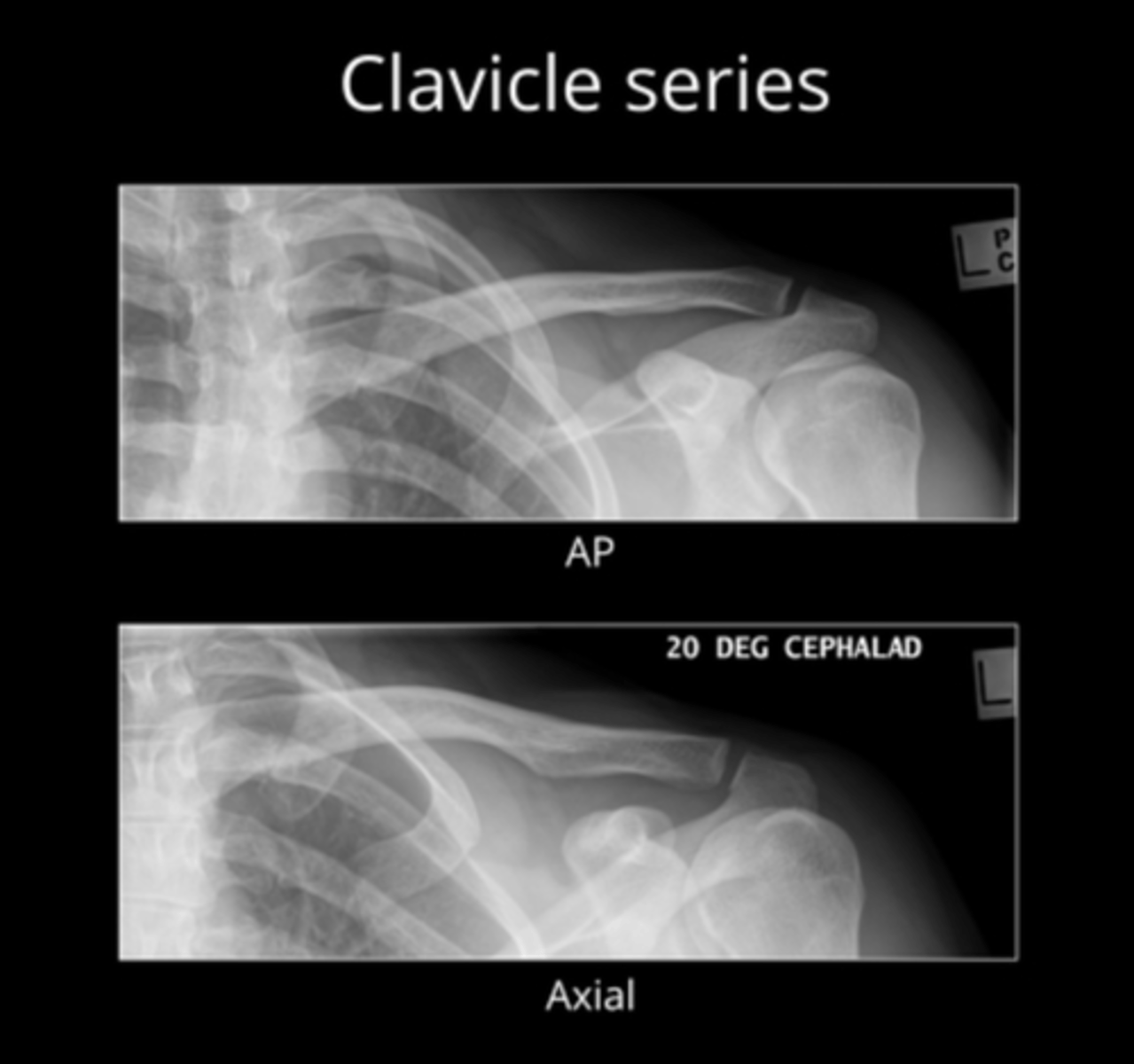 <p>A complementary projection is obtained by obliquing the incidence of the X-ray beam to achieve a partially infero-superior vision.</p>