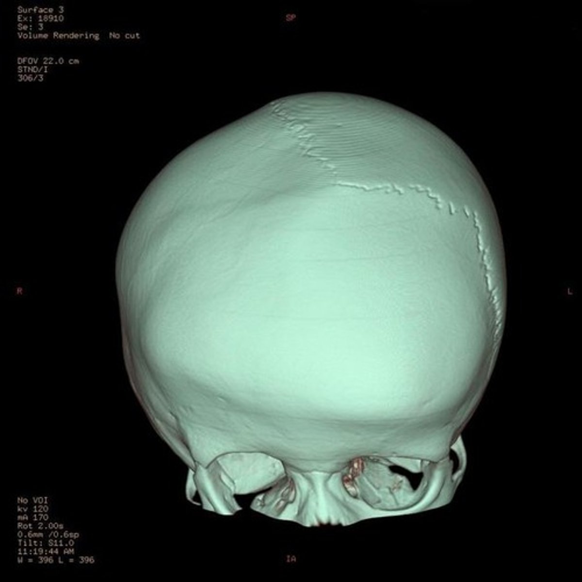 <p>one-sided closure of the coronal suture resulting in bulging at the contralateral forehead</p>