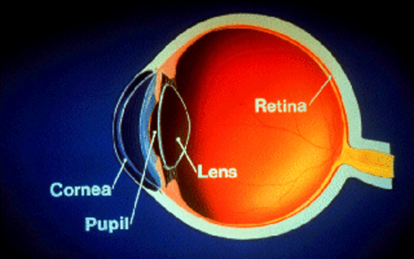 <p>-trouble with near vision; lens cannot accommodate</p><p>- inability of lens to change shape</p><p>(think of parents reading dinner menu)</p><p>-think as being far-sighted, the lens is too short so we need convex lens to help fix</p><p>-cranial nerve III - ciliary muscle = lens accommodation</p>
