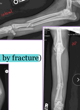 <ul><li><p><span style="background-color: transparent;"><strong><span>Location: </span></strong></span></p><ul><li><p><span style="background-color: transparent;"><strong><span>Spine, skull, joints:</span></strong><span> require special imaging (CT, oblique, stress views)</span></span></p></li><li><p><span style="background-color: transparent;"><strong><span>Long bones:</span></strong><span> Epiphysis, Physis (growth plate), Metaphysis, Diaphysis, Articular</span></span></p><ul><li><p><span style="background-color: transparent;"><u><span>Salter-Harris = Physeal Fractures</span></u></span></p><ul><li><p><span style="background-color: transparent;"><u><span>Common in young animals (open physes)</span></u></span></p></li></ul></li></ul></li></ul></li></ul><ul><li><p><span style="background-color: transparent;"><strong><span>Gustilo/Anderson Grading system: </span><u><span>Open fractures!</span></u></strong></span></p><ul><li><p><span style="background-color: transparent;"><strong><span>Grade I: </span></strong><span>inside-out, puncture <1 cm, clean</span></span></p></li></ul></li></ul><ul><li><p><span style="background-color: transparent;"><strong><span>Grade II: </span></strong><span>wound >1 cm, mild soft tissue trauma, no flaps</span></span></p></li><li><p><span style="background-color: transparent;"><strong><span>Grade III: </span></strong><span>extensive trauma, skin loss, exposed bone</span></span></p></li></ul><img src="https://knowt-user-attachments.s3.amazonaws.com/ab6848c0-df10-4f46-a604-d797876d2ddc.png" data-width="75%" data-align="center"><p></p>