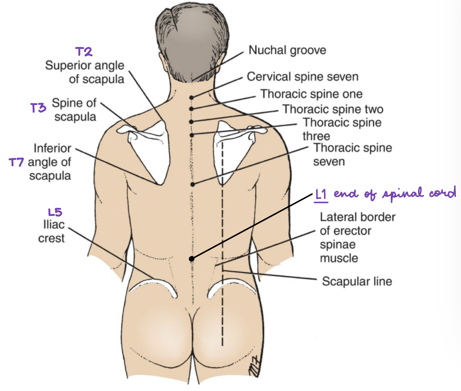 Which corresponding structure is the landmark of L5?

a. end of dural sac

b. tubercle of iliac crest

c. umbilicus

d. end of spinal cord