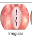 <p>lesions different on both sides at different points</p>