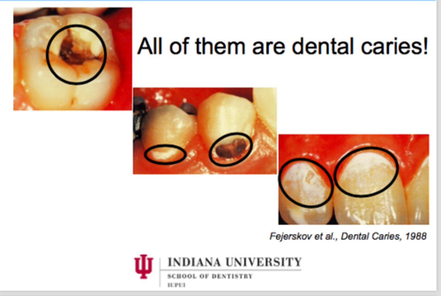 <p>All of them are caries, caries are NOT just big holes in the teeth</p>