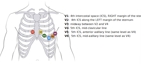 <p>V1: 4th intercostal space, right margin of the sternum</p><p>V2: 4th intercostal space, left margin of the sternum</p><p>V3: midway between V2 and V4</p><p>V4: 5th intercostal space, mid-clavicular line</p><p>V5: 5th intercostal space anterior axillary line (same level as V4)</p><p>V6: 5th intercostal space mid-axillary line (same level as V4)</p>