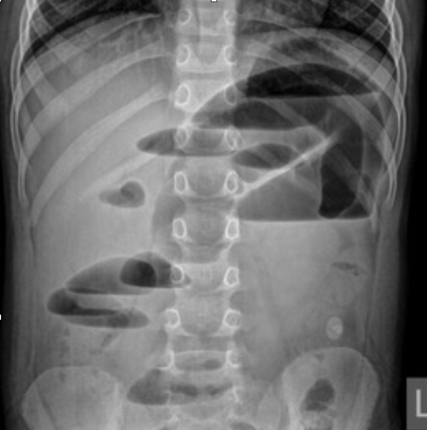 <p>dilation and multiple bubbles, air fluid levels</p><p><em>Abdominal Radiograph</em></p>