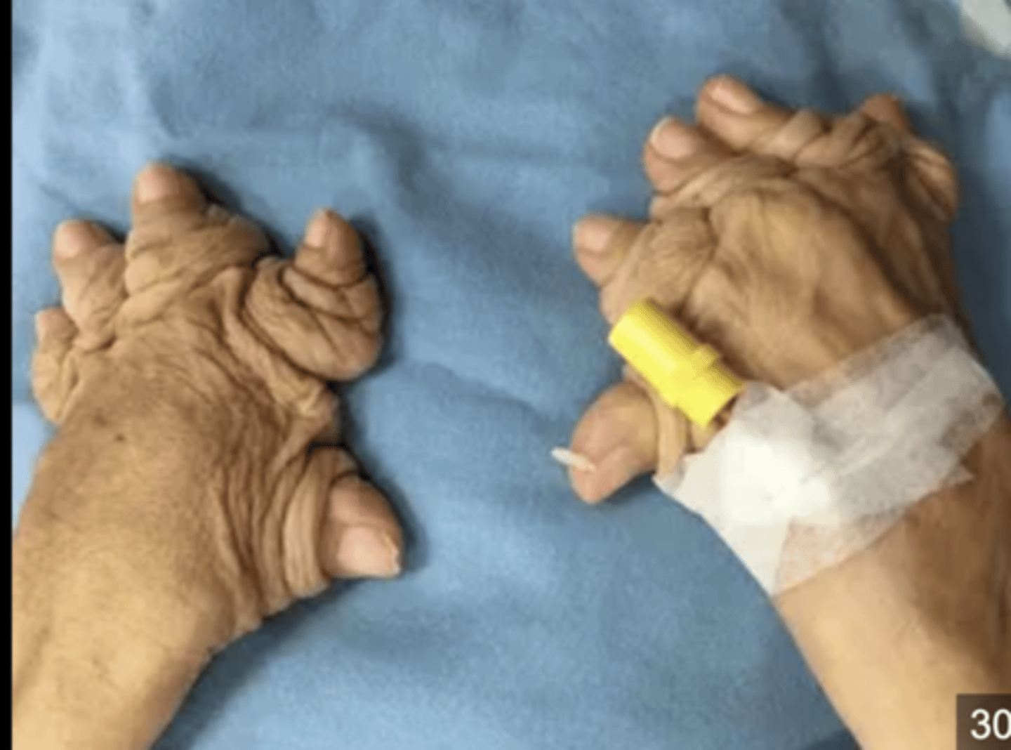 <p>1. Asymmetric oligoarticular arthritis </p><p>- 4 or fewer joints are involved; </p><p>- most common form at presentation although this may become polyarticular with time</p><p>2. Polyarticular arthritis </p><p>- is usually symmetrical and presents similarly to rheumatoid arthritis, although distal interphalangeal joints are more likely to be involved than metacarpophalangeal joints</p><p>3. Distal interphalangeal disease </p><p>- affects the distal interphalangeal joints only; nail changes are especially common</p><p>4. Arthritis mutilans </p><p>- is a severely destructive arthritis with resulting deformities including telescoping of digits</p><p>5. Spondyloarthritis involves sacroiliitis and involvement of the spine, often with concurrent peripheral joint involvement</p>
