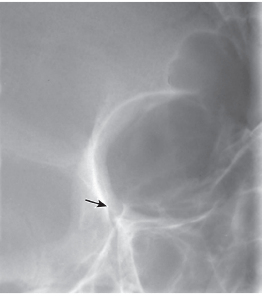 <p>Repeatable errors (three)—</p><p>Criterion 1: Anatomy demonstrated: Optic foramen is distorted and into lateral orbital wall due to poor positioning. </p><p>Criterion 2: Positioning: Skull appears to be overextended. (The AML was not perpendicular.) This projects the optic foramina into the infraorbital rim structure. The skull also appears to be under-rotated, toward a lateral position. </p><p>Criterion 5: Anatomic side markers: There is no evidence of anatomic side markers</p>