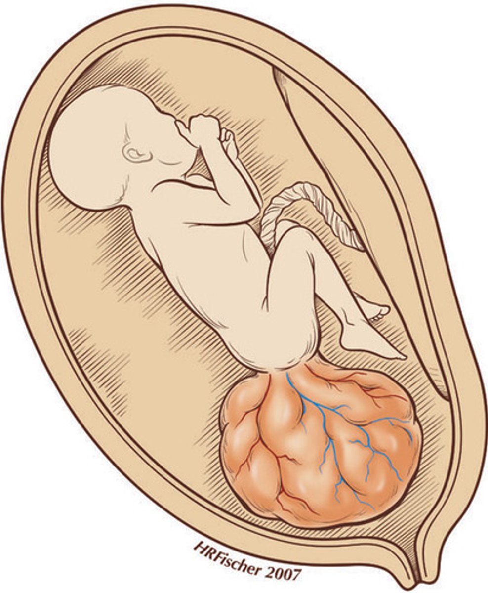 <p>Sacrococcygeal teratomas</p>