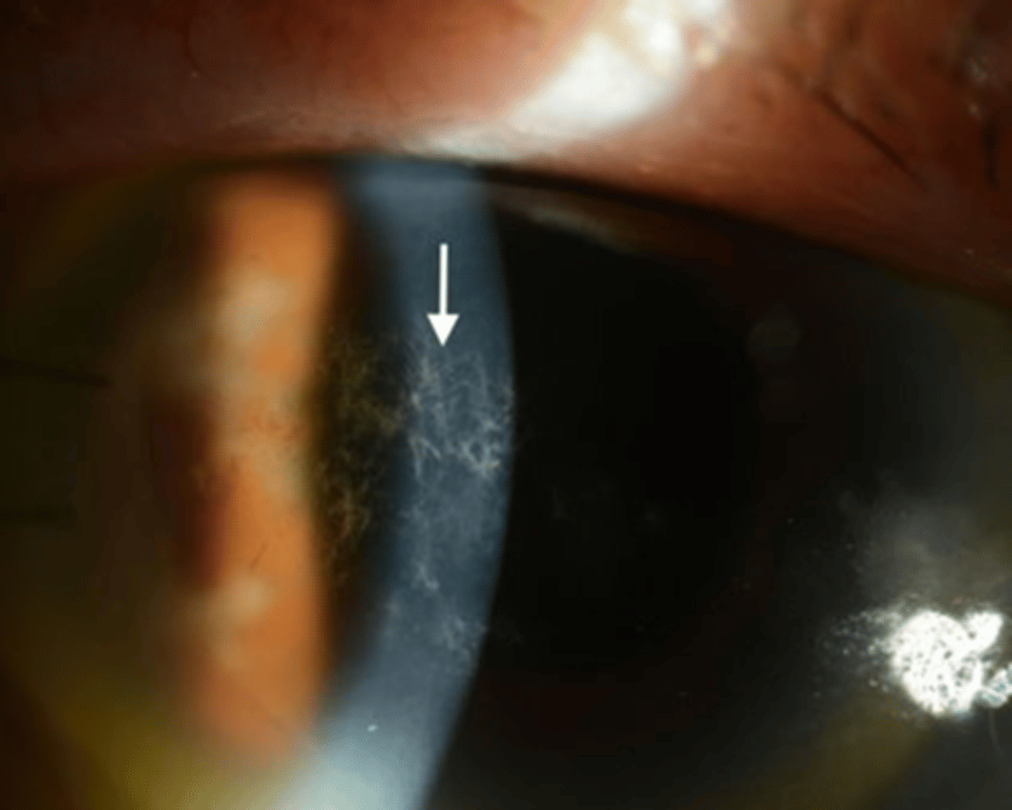 <p>What is crystalline keratopathy that occurs from chronic topical steroid use?</p>