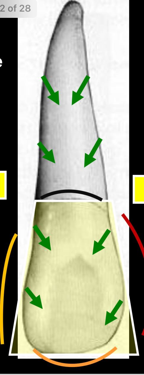 <p>due to lingual convergence, which is to accommodate the horseshoe shaped alveolar process, making it narrower and smaller than the labial surface </p>