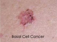 Basal cell carcinoma