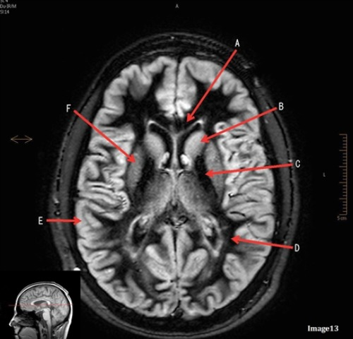 <p>Letter F in Image 13 is pointing to:</p><p>A. Grey matter</p><p>B. White matter</p><p>C. Lentiform nucleus</p><p>D. Caudate nucleus</p><p>E. Internal capsule</p>