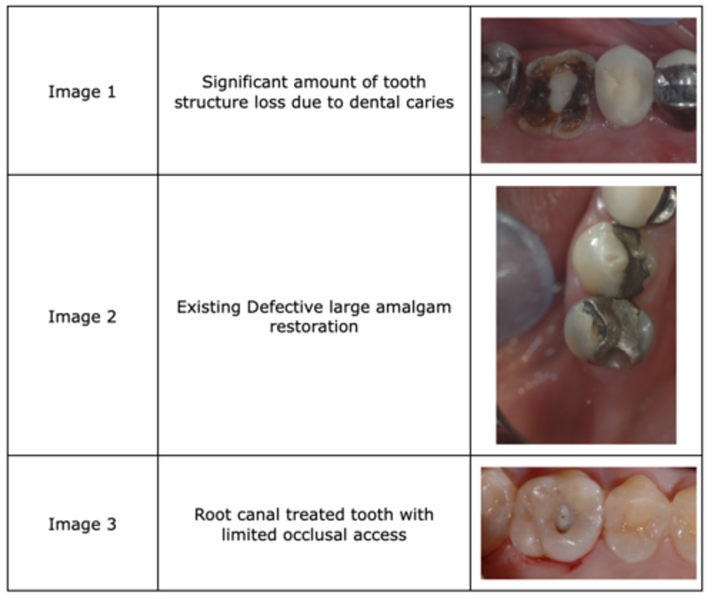 <p>Following are the reasons that dictate your first treatment option for a crown. Which one is not always true?</p><p>A) Image 1: Significant amount of tooth structure loss due to dental caries</p><p>B) Image 2: Existing Defective large amalgam restoration</p><p>C) Image 3: Root canal treated tooth with limited occlusal access</p>