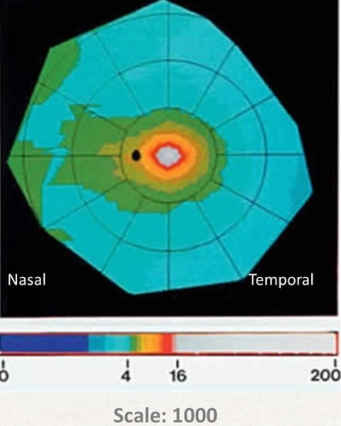 <p>Are there more cones in the nasal or temporal retina?</p><p></p><p>**on a topography map, results in a <strong>cone ____ streak</strong></p>