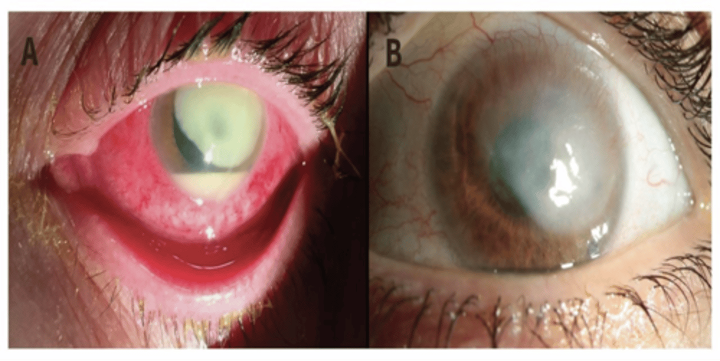 <p>Pseudomonas Aeruginosa</p><p>*In the eye, P. aeruginosa is a common cause of bacterial keratitis, particularly in contact lens wearers. It is known to be particularly virulent, with pseudomonas keratitis being more difficult to treat and have worse prognosis than other forms of bacterial keratitis.</p><p>* P. aeruginosa secretes proteases that can cause liquefactive necrosis of the cornea, leading to rapid corneal weakening and perforation.</p>