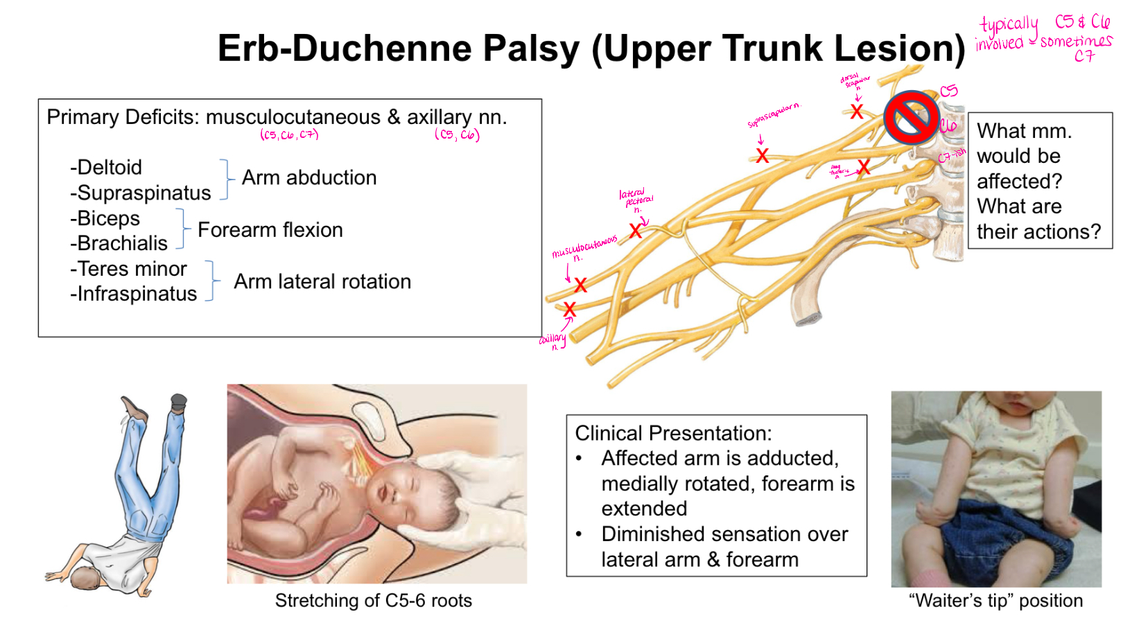 <p>Upper Trunk Lesion</p><p>Typically C5 and C6 involved</p><p>Clinical Presentation:</p><p>-affected arm is adducted, medially rotated, forearm is extended</p><p>-diminished sensation over lateral arm and forearm</p>
