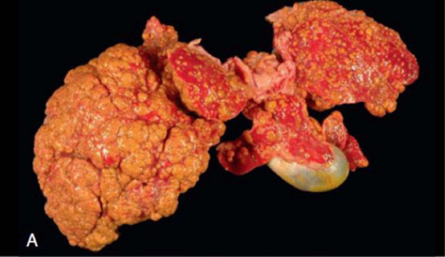 <p>Cirrhosis</p>