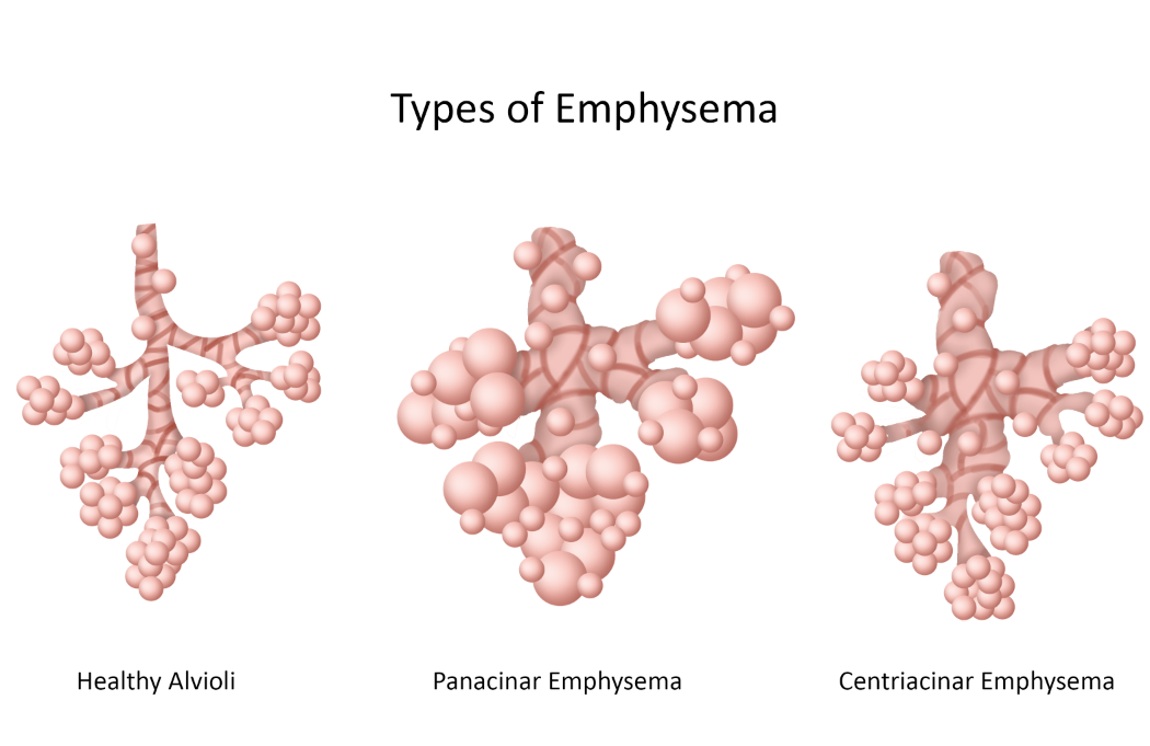 <p>this type of emphysema affects respiratory bronchioles and alveolar ducts, typically in the <mark data-color="green" style="background-color: green; color: inherit;">upper lobes,</mark> and is often seen in <strong>smokers.</strong></p><p><strong>most common </strong></p>