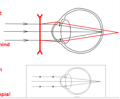 <p>image is formed behind the retina&nbsp;</p><p>called hyperopia&nbsp;</p><p>lens spreads/diverges light rays before they enter the eye</p><p>rays are now diverging instead of parallel when they reach conrea&nbsp;</p><p>eyes normal converging power isnt enough to bring them to focus on the retina so they fall behind the retina - light converges later&nbsp;</p><p>&nbsp;distat blurry&nbsp;</p>