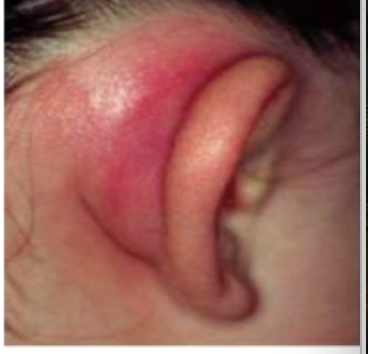<p>Patient presents to the clinic for ear pain and malaise. Patient reports that they were recently diagnosed with otitis media. Vitals are stable with the exception of a 102.4 temperature. On a physical exam you note, the mastoid is tender and warm on palpation, retroauricular edema, and erythema is present. You also notice a protruding auricle and the loss of the postauricular crease.  What do we need to order. </p>