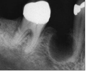 <p>What are common differential diagnoses for odontogenic keratocyst?</p>