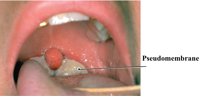 <p><span><span>Agent: </span><em><span>C. diptheriticae</span></em></span></p><p><span style="background-color: transparent;"><span>C. diptheriticae has a </span><strong><span>lysogenic phage</span></strong><span> that codes for the diptheria toxin</span></span></p><p><span style="background-color: transparent;"><span>Symptoms: sore throat fever pain </span></span></p><p><span style="background-color: transparent;"><strong><span>Pseudomembrane:</span></strong><span> intracellular fluid, blood clotting factors, leukocytes, bacteria, and remains of dead cells</span></span></p>